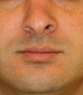 Feel Beautiful - Rhinoplasty 215 - Before Photo